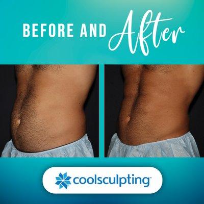 CoolSculpting Elite provides non-invasive fat destruction. Ready to try it out?