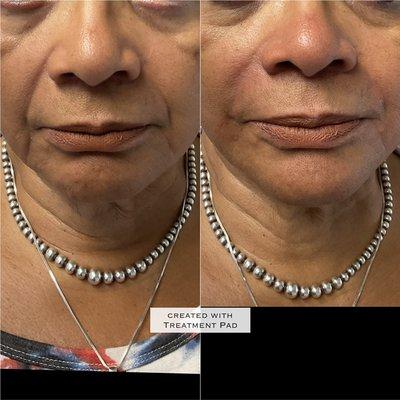 Dermal fillers. Magic in a vial!