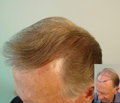 Coverage Area: 120 cm2 Donor Area: 30 cm2 Density: 25% Graft Number: 1653 grafts Hair Regrowth Medication: Yes.