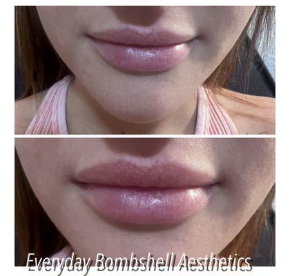 1cc Lip Filler