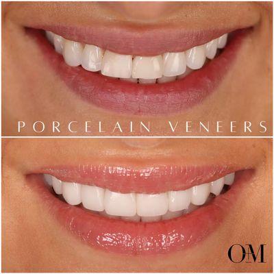 8 veneers to realign the smile