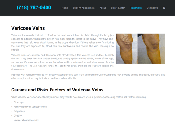 Varicose Veins Treatment