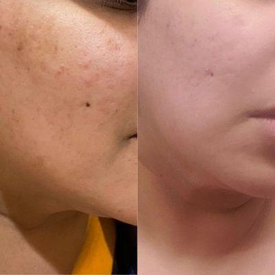 Acne scar treatment