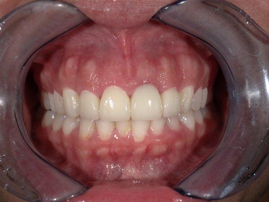 Cosmetic Makeover with Veneers