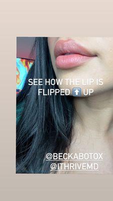 Lip flip! Amazing alternative to lip filler if you're too scared to fill them in!