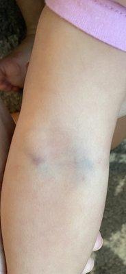 Daughter's bruised arm