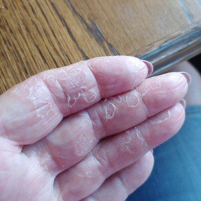 Peeling Fingers