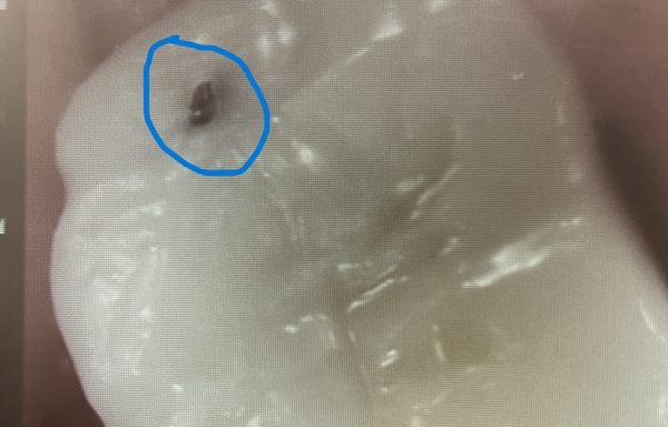 Blue circle shows large hole at top of crown that Dr. Richard Hada missed from Sept 2023 through January 2024!