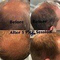 Struggling with hair loss? Discover the power of PRP therapy!