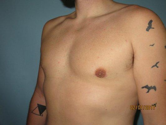 After male breast reduction procedure (gynecomastia) Patient A