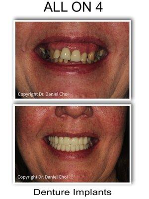 All on 4 Dental Implants - before and after