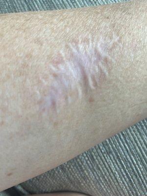 Horrible scar from melanoma removal