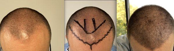 Our advanced hair transplant techniques have allowed us to recreate a flawless, natural hairline that seamlessly blends with your own hair.