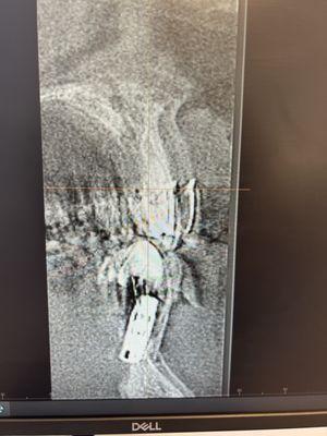 Front implant x sect showing perforation