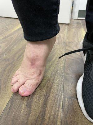 Happy patient showing off her range of motion post severe bunion correction :)