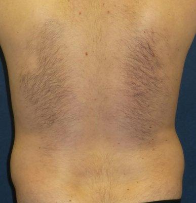 Male, 36 yr old BEFORE LIPOSUCTION FLANKS