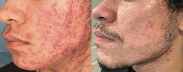 Amazing acne transformation by Dr. Julie Kenner with her specially formulated topical prescriptions and products!