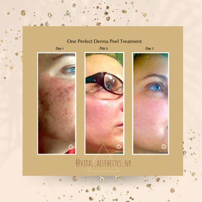 The Perfect Derma chemical peel, results