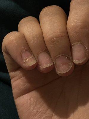 Nail damage from acrylic nail tip removal