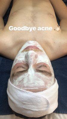 Acne facial