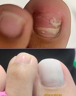 Toenail Restoration