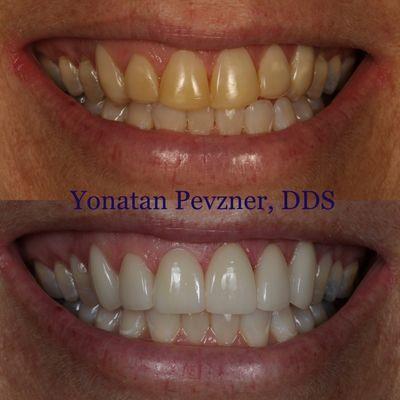 Before & After Porcelain Veneers