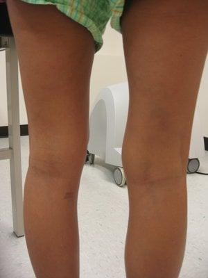 Varicose Veins Patient 1 After