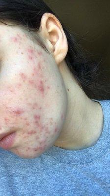 Acne before and after