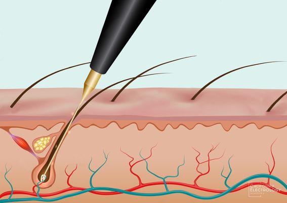 OC Electrolysis and Skin Care