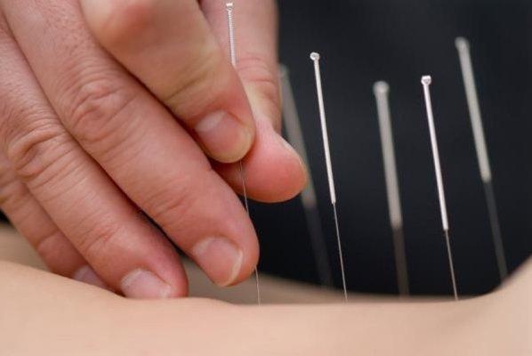 Acupuncture