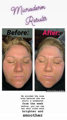 Microdermabrasion Facial