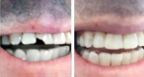 This is the chipped tooth he fixed -- perfection!