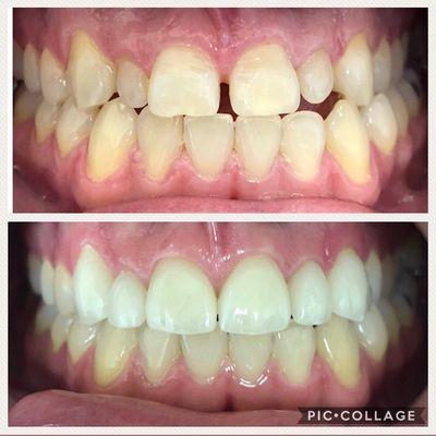 Six veneers were placed for this awesome smile makeover!! We love the natural looking results!