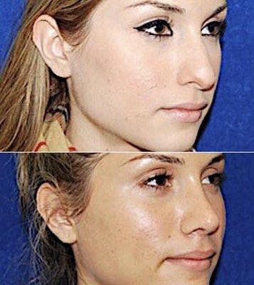 Rhinoplasty