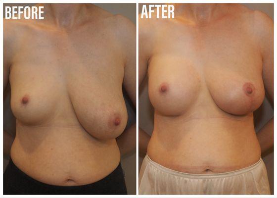 Breast Augmentation Asymmetry