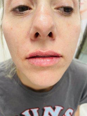 After lip injections