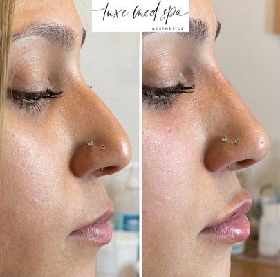 Non-Surgical Rhinoplasty (Nose Job) in Orlando, FL