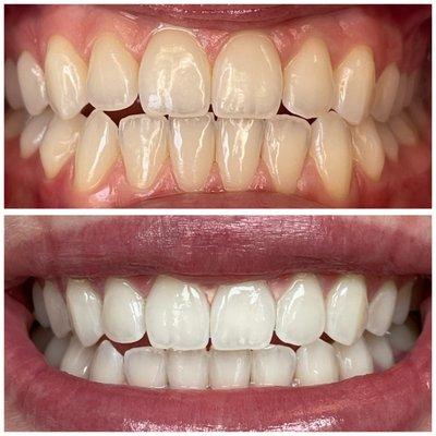 Teeth Whitening, 2nd session, 60 min.