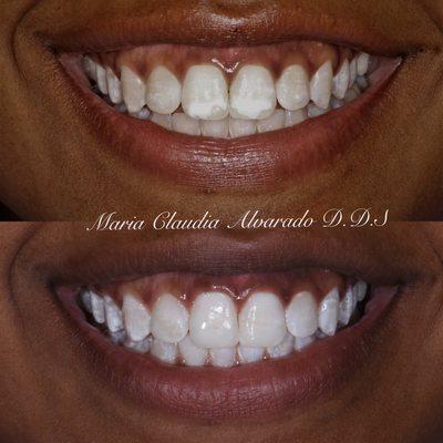 Cosmetic dental work performed by Dr. Alvarado