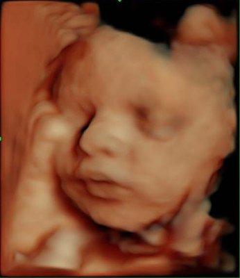 3D/4D/HD Live Ultrasound