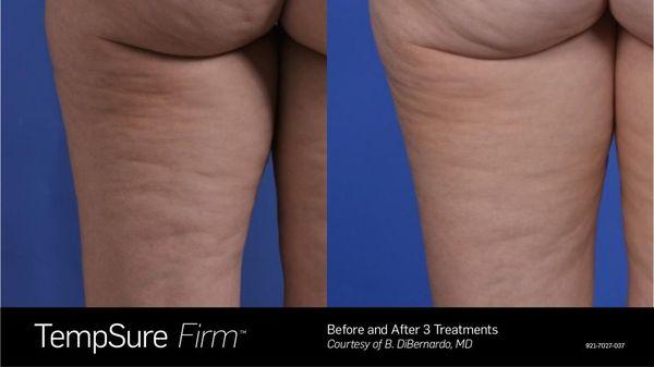 Cellulite Reduction with TempSure