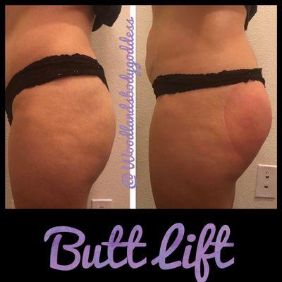 Non surgical butt lift