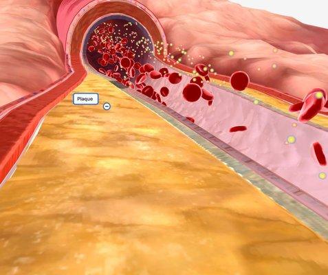 Example of Peripherial Artery Disease treated by USA Vascular Centers