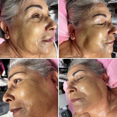 Anti aging customized Facial