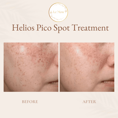 Helios Pico Spot Treatment