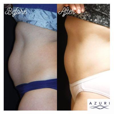 Before & After of Evolve Body Contouring/Sculpting Treatment.