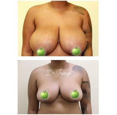 Breast reduction and lift