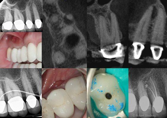 Diagnosis made with the aid of 3 dimensional imaging.