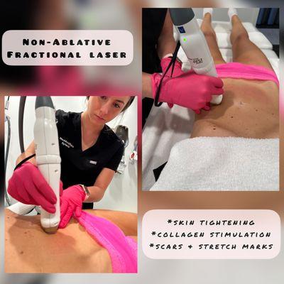 Non-Ablative Fractional Laser