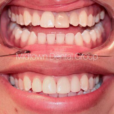 Have a discolored front tooth? Don't be discouraged! This patient got her confident smile back with in-office internal bleaching and veneers